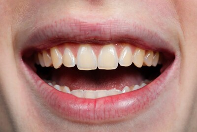 Closeup of wide open mouth smiling